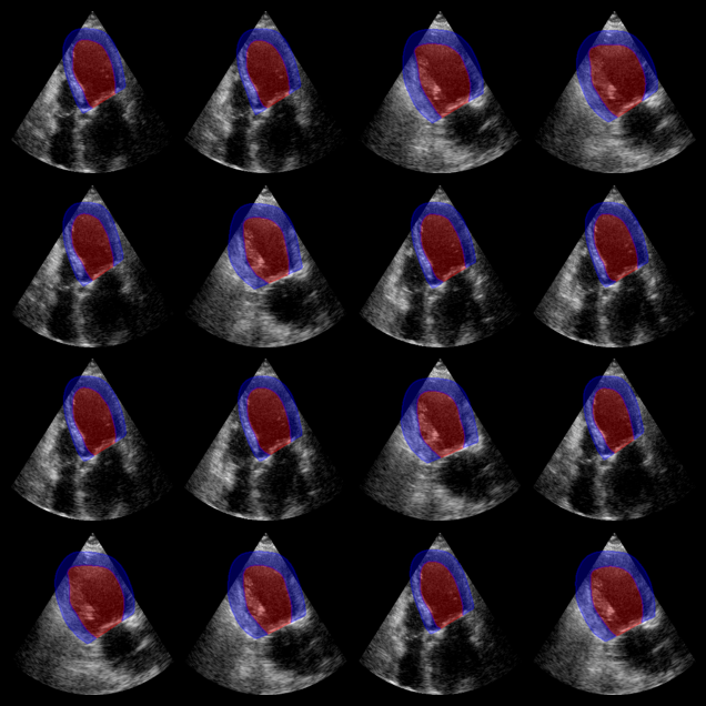 Augmented CAMUS Segmentation Output