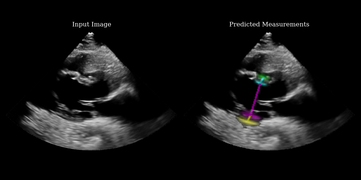 EchoNetLVH Example Output